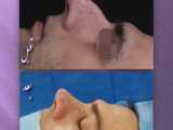 نتیجه جراحی زیبایی بینی | دکتر سید رضا رفیع | جراح بینی