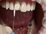 درمان کامپوزیت ونیر | کلینیک تخصصی دندانپزشکی کانسپتا 