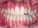 نمونه درمان ارتودنسی ثابت | کلینیک تخصصی دندانپزشکی کانسپتا 