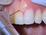 لیفت لثه با لیزر | کلینیک تخصصی دندانپزشکی کانسپتا 