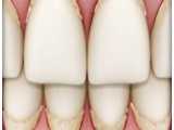 بیماری لثه (ژنژویت) | کلینیک دندانپزشکی ایده آل 