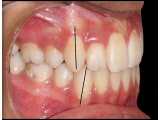 نامرتبی شدید دندانها | کلینیک دندانپزشکی ایده آل 