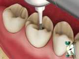 اینله کردن دندان ها چیست ؟ | کلینیک دندانپزشکی ایده آل 