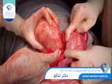 1400.03.23 - عمل جراحی توده های فیبرومی در دختر 28 ساله