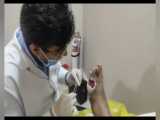 آموزش درمان زخم پای دبابتی با روش وکیوم تراپی 