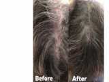 رشد مجدد مو با مزوتراپی-موگه کلینیک