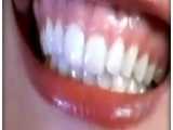 لبخند لثه ای (گامی اسمایل) | کلینیک دندانپزشکی ایده آل 