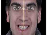 ارتودنسی ثابت دو فک جهت بستن فضای غیر دندانی | کلینیک دندانپزشکی ایده آل 
