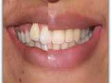 جایگزینی دندان نیش به جای دندان لترال | دکتر سعید قریشی 