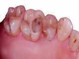 عصب کشی دندان چهار کاناله | کلینیک سیمادنت