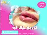 فیلم تزریق ژل لب توسط کتر پورفخاران 48000100