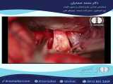 جراحی مننژیوم قاعده جمجمه (توبرکولوم سلا)