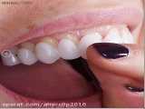 لمینت متحرک دندان - Snap On Smile خرید به صورت انلاین