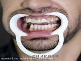ایمپلنت دندان   لمینت دندان در اصفهان