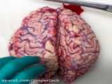 نمایی از داخل مغز وقتی دچار سکته شده/لطفا اگر بد دلید نبینید.