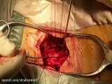 جراحی تومور نخاعی