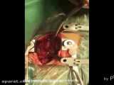جراحی پلاتین گذاری و تنگی کانال نخاعی گردنی