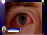 التهاب چشم آلرژی 