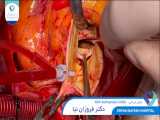 1400.05.24 - عمل جراحي AVR Aortoplasty CABG