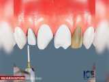 لمینیت دندان چگونه انجام میشود؟