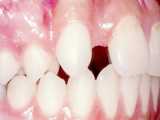 ارتودنسی دندان غایب برای ایمپلنت | دکتر داودیان