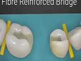 بریج دندانپزشکی تقویت شده با فیبر 