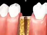 بررسی پروسه ایمپلنت دندان 