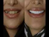 تبدیل دندان شیری به دائمی و لمینت دندان