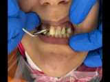 درمان ایمپلنت دندان و کامپوزیت دندان