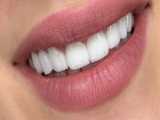 کامپوزیت دندان یا لمینت دندان ؟