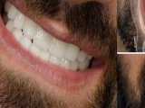 فیلم 20 واحد لمینت دندان برای مراجعه کننده عزیز 