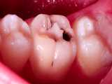 ترمیم همرنگ دندان | کلینیک سیمادنت