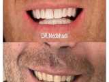 آیا می دانید کامپوزیت ونیر دندان چگونه انجام می شود؟ 