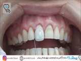 کامپوزیت دندان بدون تراش 
