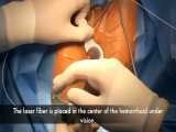 درمان بواسیر با لیزر در 20 دقیقه - ویدیو 