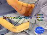 لیفت بازو یا براکیوپلاستی | تیم جراحی ایرامین