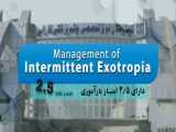 Managemant of Intermittent Exotropia - 1400.07.08