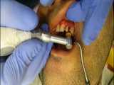 رفع پوسیدگی دندان ها قبل از کامپوزیت