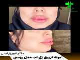 نمونه تزریق ژل لب مدل روسی