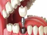 ایمپلنت دندان به روش آسان _ آموزش کاشت دندان