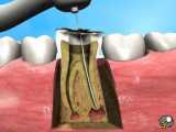 عصب کشی دندان بدون درد