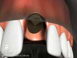 مراحل کاشت ایمپلنت دندان 
