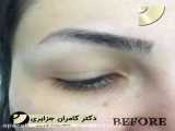 تصاویر قبل و بعد از کاشت ابرو