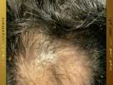 درمان قطعی ریزش مو با مزوتراپی
