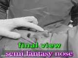 کنترل نهایی جراحی بینی نیمه فانتزی