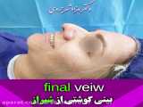 جراحی زیبایی بینی گوشتی مراجعه کننده عزیزمون از شیراز