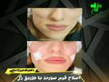 اصلاح فرم صورت با تزریق ژل