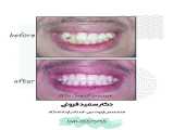 درمان بی نظمی دندانی و عدم تطابق قوسهای دندانی