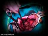 جراحی تومور نخاع گردن | دکتر محسن القاسی | جراح مغز و اعصاب