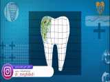 پوسیدگی دندان چگونه اتفاق می افتد؟
